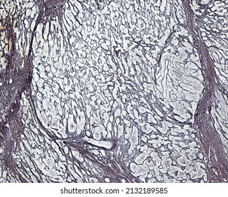 Human Liver. Cirrhosis. Silver Methods For Reticular Fibers Clearly Show The Connective Tissue Septa Surrounding The Regenerating Nodules And The Increase Of Connective Tissue Fibers (fibrosis)