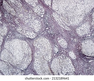 Human Liver. Cirrhosis. Silver Methods For Reticular Fibers Clearly Show The Connective Tissue Septa Surrounding The Regenerating Nodules Of Hepatocytes.