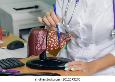 Human Liver Model With Words Normal, Fibrotic, Cirrhotic, Cancerous. Woman Doctor Shows The Patient Liver Of Stage 4: Normal, Fibrous, Cirrhotic, Malignant. Liver Means Your Health And Your Life.