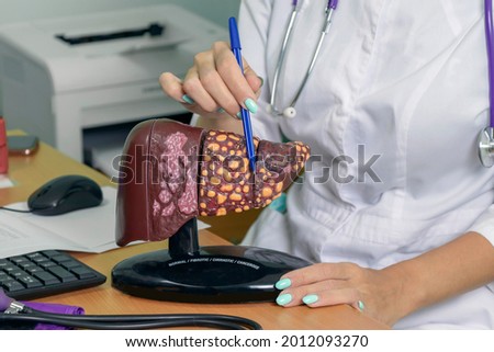 human liver model with words normal, fibrotic, cirrhotic, cancerous. woman doctor shows the patient liver of stage 4: normal, fibrous, cirrhotic, malignant. Liver means your health and your life.