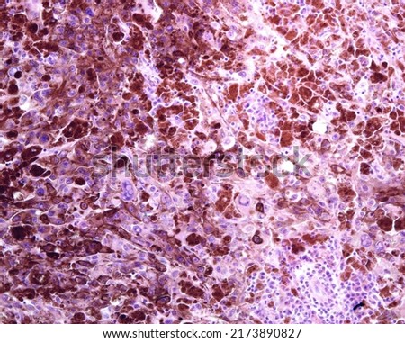 Human lymph node. Metastasis of a malignant melanoma. The normal lymphoid tissue of lymph node has completely disappeared and has been replaced by malignant melanoma pigmented and non-pigmented cells.