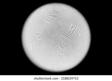 Human Melanoma (skin Cancer) Cells Cultured In Vitro. Microscopic Phase Contrast Image. Cancer Cells Are Used In Biomedical Research, Drug Discovery, Cell Signalling And Genetics. 