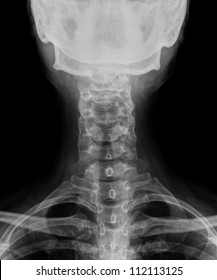 Human Neck Bone And Skull Xray Picture