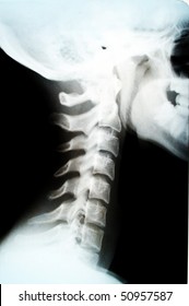 Human Neck Bone And Skull Xray Picture