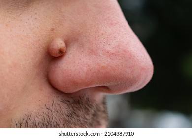 Human nose with wart or papilloma