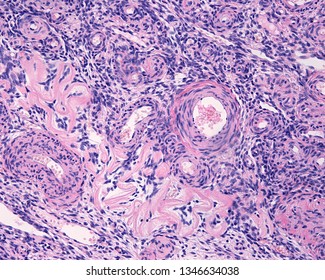 Human Ovary. Late Stage Of Follicular Atresia. The Folded Pink Structure Is The Glassy Membrane A Remnant Of The Basement Membrane Of A Atretic Follicle.