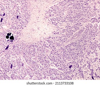 
Human pineal gland. Glial scar formed by the second type of pineal parenchyma cells, the glial cells. They are similar to glial scars formed by astrocytes in CNS lesions.