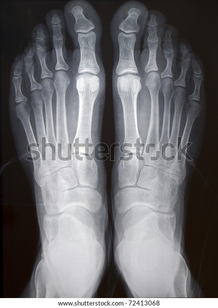 Human Right Left Foot Ankle Xray Stock Photo (Edit Now) 72413068