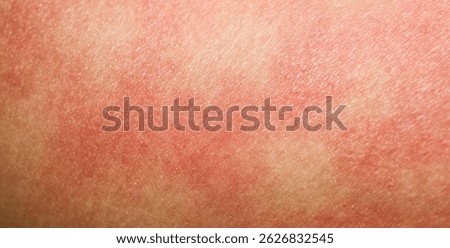 Human skin background texture dermatitis rash