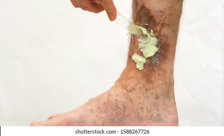 Human skin disease. Human hands apply ointment to scars, ulcers, peelings and age spots on his foot. Perhaps this is varicose veins or thrombosis on the leg. Close-up.