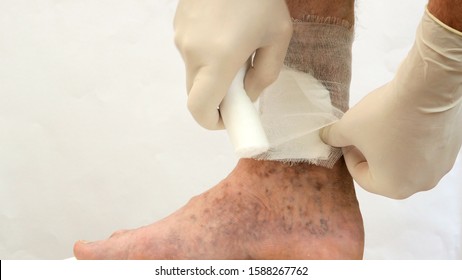 Human skin disease. Human hands swathe with bandage, around scars, ulcers, peelings and age spots, possibly due to varicose veins or thrombosis on his leg. Close-up.
