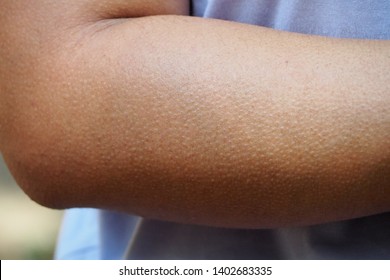 Human Skin Getting Goosebumps On Arm When Feeling Cold Or Creepy Seeing Something Haunted Or Shocked. Human Mechanism To Protect Body From Such Strong Emotional Environment. 