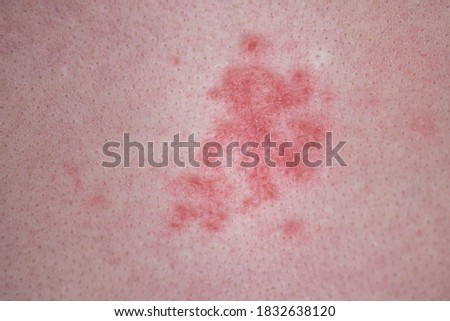 Human skin with red allergic spots, sores