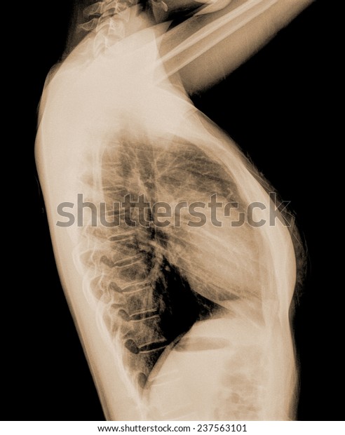 Human Thorax Radiography Side View Stockfoto Shutterstock