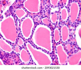 Adenoma Images, Stock Photos & Vectors | Shutterstock