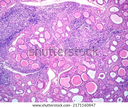 Human thyroid. Chronic thyroiditis (Hashimoto disease). Low magnification micrograph showing extensive chronic inflammatory infiltrates and lymphoid follicles with germinal centers.