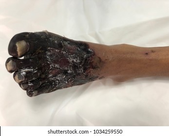 Human Tissue Skin With Gangrene Foot Disease.