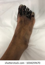 Human tissue skin with gangrene foot disease.