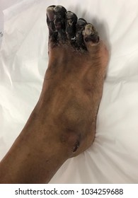 Human Tissue Skin With Gangrene Foot Disease.