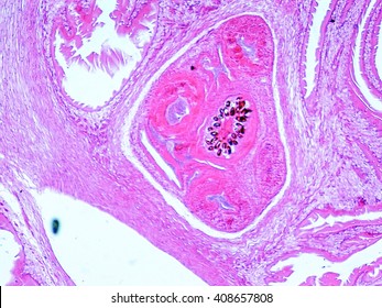 Hydatid Cyst Of Lung Caused By Tapeworm Parasite Echinococcus Granulosus, Light Micrograph, X50