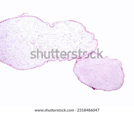Hydatidiform mole. It is a mass of hydropic swollen chorionic villi, with edematous, myxomatous and loose stroma, looking like grapes. There are also zones of trophoblast hyperplasia.