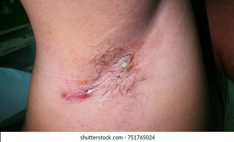 Infected Hair Follicle Images Stock Photos Vectors