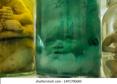 Hydrocephalus Baby Head In Jar With Formalin Solution