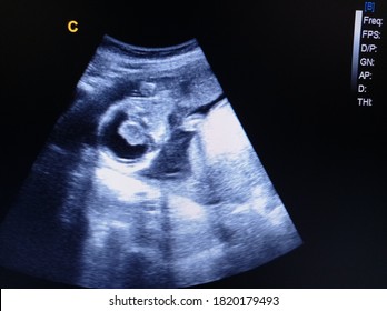 Hydrocephalus Fetus 18 Weeks By Ultrasound Stock Photo 1820179493 ...