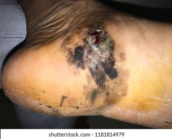 Hyper Pigmented  At Plantar Of Foot With Chronic Ulcer  , It Look Like Malignant Melanoma .