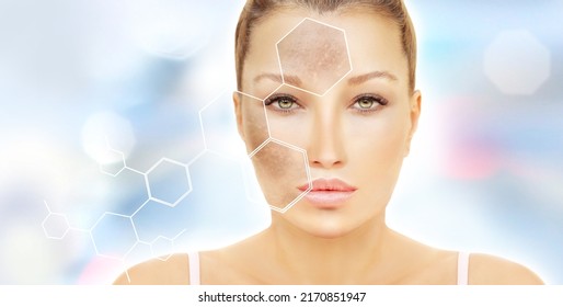 Hyperpigmentation: chloasma, melasma , age spots,Post-inflammatory hyperpigmentation.Hyperpigmentation removal - Shutterstock ID 2170851947