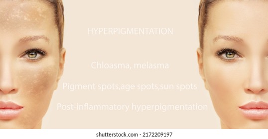 Hyperpigmentation Chloasma Melasma Age Spotspostinflammatory ...