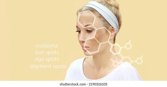 Hyperpigmentation Chloasma Melasma Age Spotspostinflammatory 