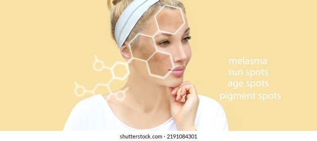 Hyperpigmentation Chloasma Melasma Age Spotspostinflammatory ...