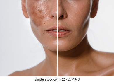 Hyperpigmentation of female skin, close-up of a part of the face on a white background, before and after acid peeling and cosmetic therapy, dermatology, skin care - Shutterstock ID 2171144943