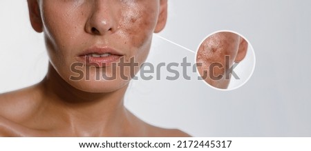 Hyperpigmentation of female skin, close-up of a part of the face on a white background, cosmetology, dermatology, skin care