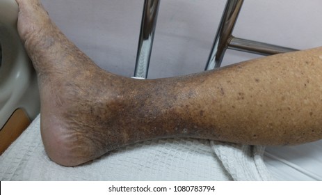 Hyperpigmentation Lower Limb Die To Chronic Venous Insufficiency.