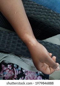 Hyperpigmentation (white Spot) After Corticosteroid Injection As A Result Of De Quervain Tenosynovitis