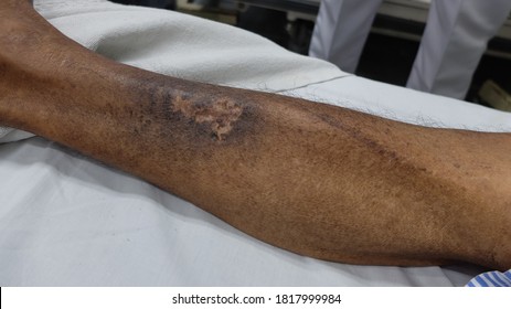 Hyperpigmented Lower Limb As Asign Of Chronic Venous Insufficiency.