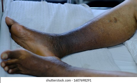 Hyperpigmented Lower Limb With Lipodermatosclerosis And Varicose Vein In Chronic Venous Insufficiency.