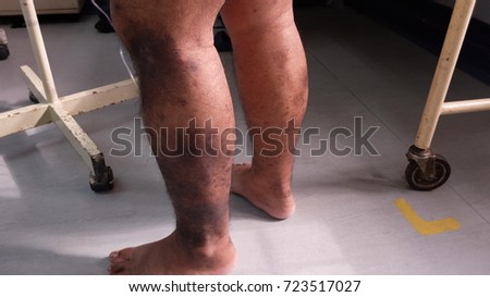 Hyperpigmented Lower limb secondary to venous insufficiency.