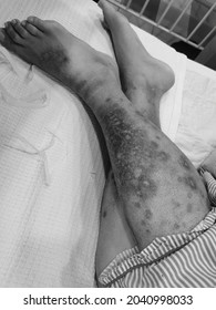 Hyperpigmented Lower Limbs In Chronic Venous Insufficiency. 