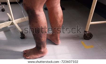Hyperpigmented lower limbs due to Chronic Venous Insufficiency