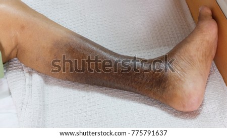 Hyperpigmented lower limbs due to Chronic Venous Insufficiency.