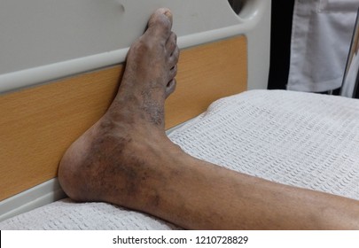 Hyperpigmented Lower Limbs With Varicosities Suggested Chronic Venous Insufficiency.