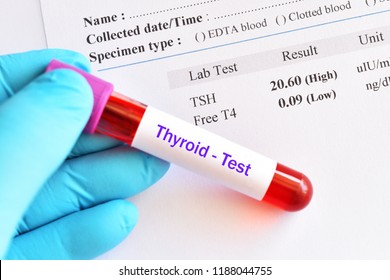 Hypothyroidism Result With Blood Sample Tube