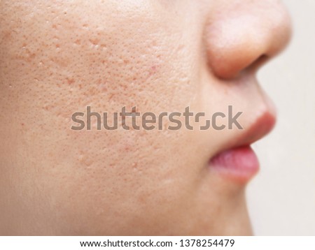 icepick scars acne on cheek on face in women cause of happen because of the overlaying skin collapses and leaves a hole, narrow and deep using for cream or beauty product Imagine de stoc © 