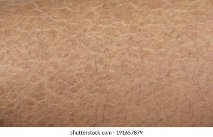 Ichthyosis Fish Skin Disease Stock Photo 191657879 Shutterstock Ichthyosis Fish Skin Disease Stock Photo 191657879 Shutterstock