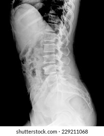 Idiopathic Scoliosis, Last Stage, Deformation Ribs