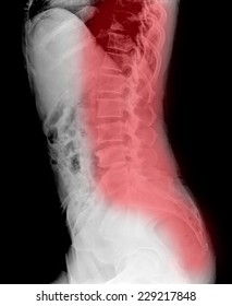 Idiopathic Scoliosis, Last Stage, Deformation Ribs