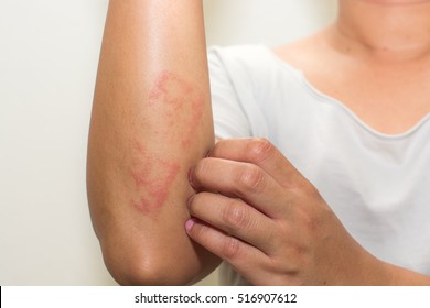 Ill Allergic Rash Dermatitis Eczema Skin Of Patient